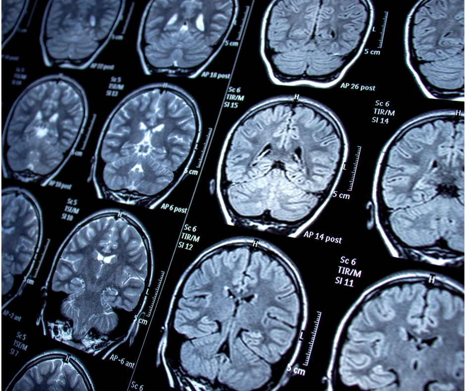 Hypnosis how does it work? fMRI scan